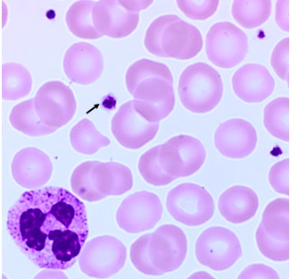 Naomi Cornish blood film